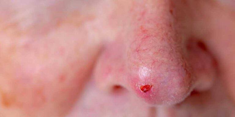 New Alarming Trend Could Cause Skin Cancer New Alarming Trend Could Cause Skin Cancer
